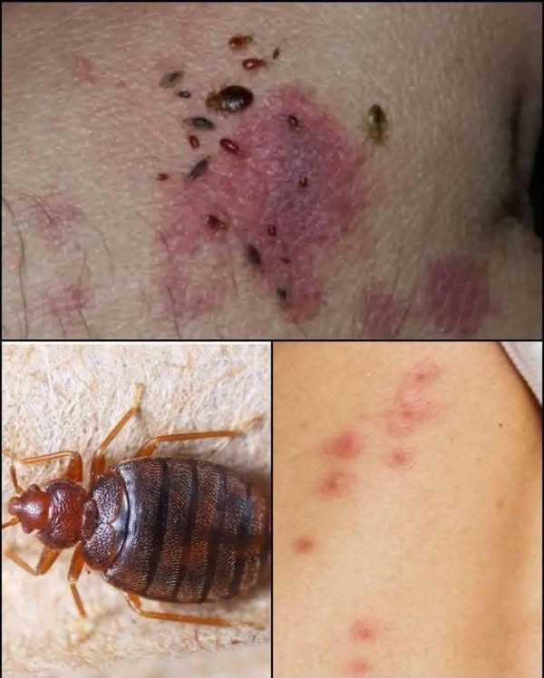 Understanding Scabies
