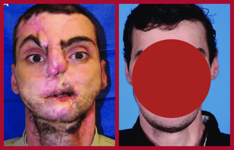 Three patients whose lives were changed after the magical surgery… See the results below…