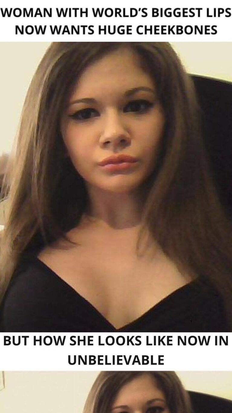 25-Year-Old Bulgarian Woman Does More Than 27 Procedures To Have The Biggest Lips In The World