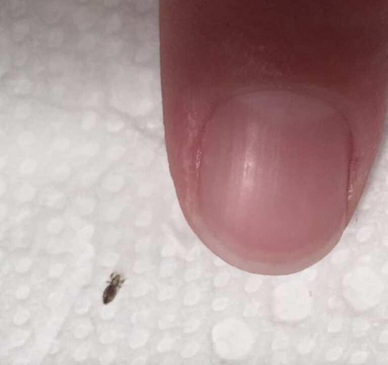 Head lice: How to get rid of them and stop them coming back