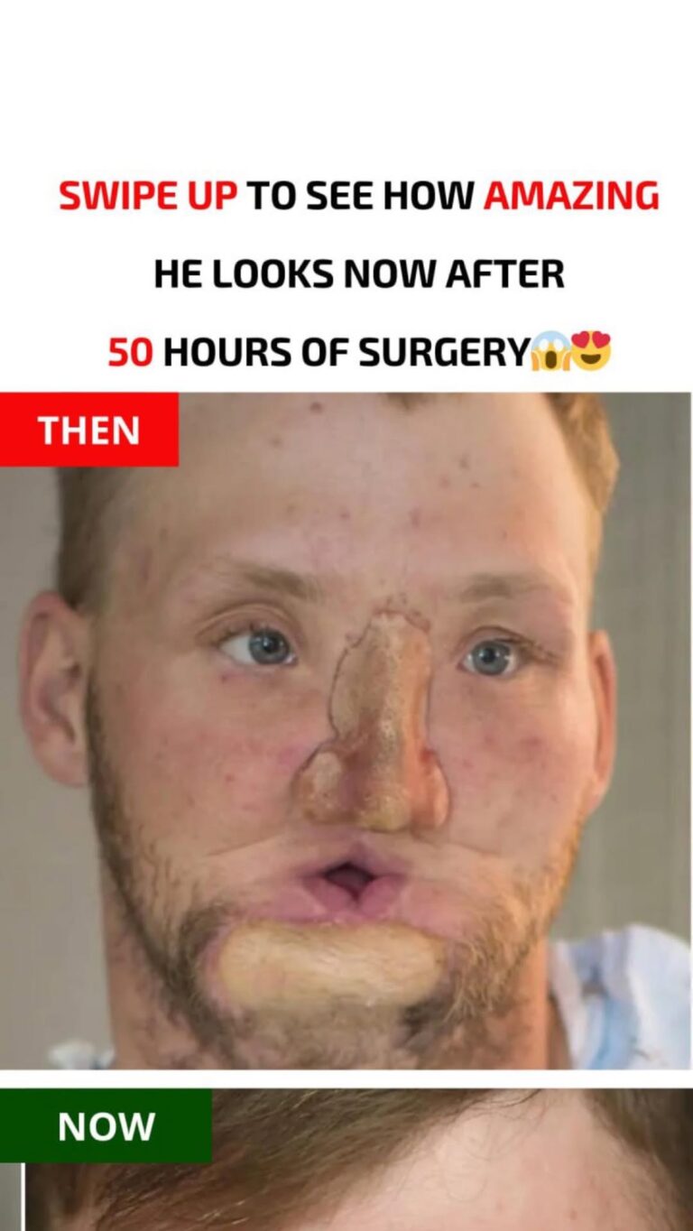 Face transplant patient overjoyed with his brand new appearance… Look how amazing he looks now…