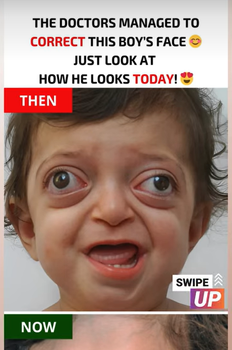 The doctors managed to correct this boy’s face. Just look at how he looks today! 😊