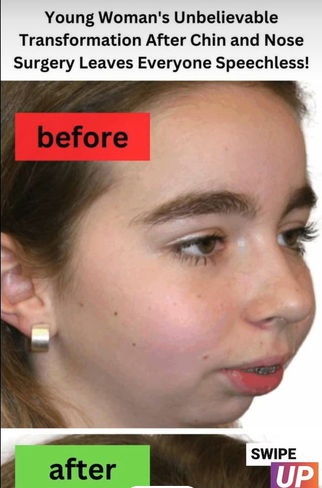 Young Woman’s Unbelievable Transformation After Chin and Nose Surgery Leaves Everyone Speechless!